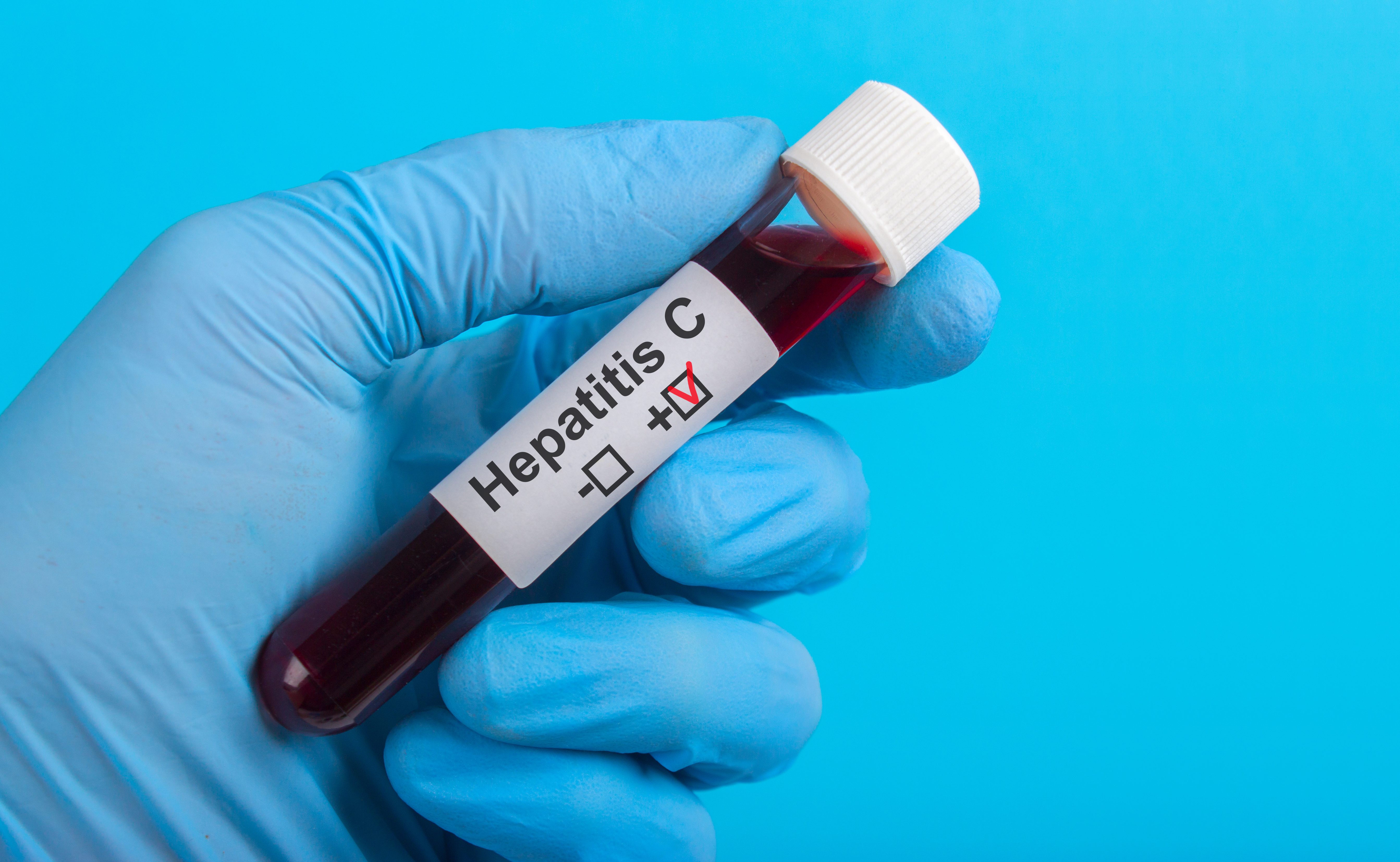 Doctor hcv. Кровь на гепатит в в пробирках. Пробирка на гепатит.